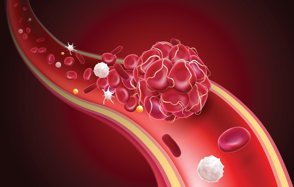 Hypertension blood clot illustration