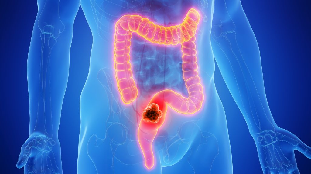 Colorectal cancer illustration