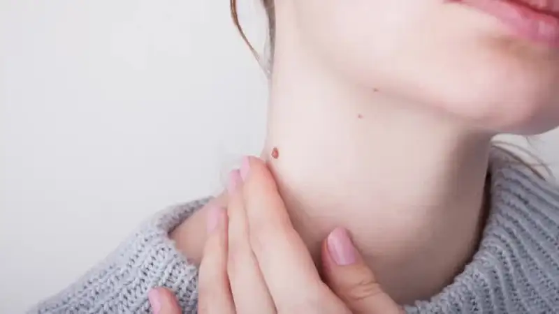 Skin tag on a woman's neck.