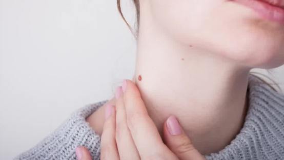 How to Rid Skin Tags and Warts Overnight – Dr. Berg Explains