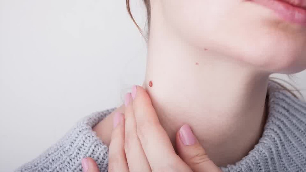 How to Rid Skin Tags and Warts Overnight – Dr. Berg Explains