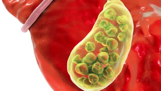 STOP Doing Gallbladder Flushes with Olive Oil
