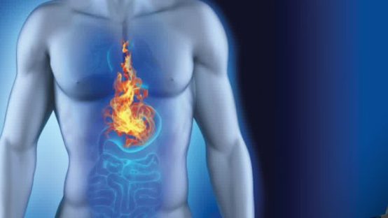 Your Quick Guide to Conquering Acid Reflux