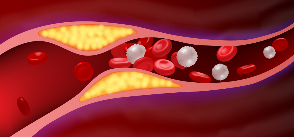 Excess fat clogging an artery