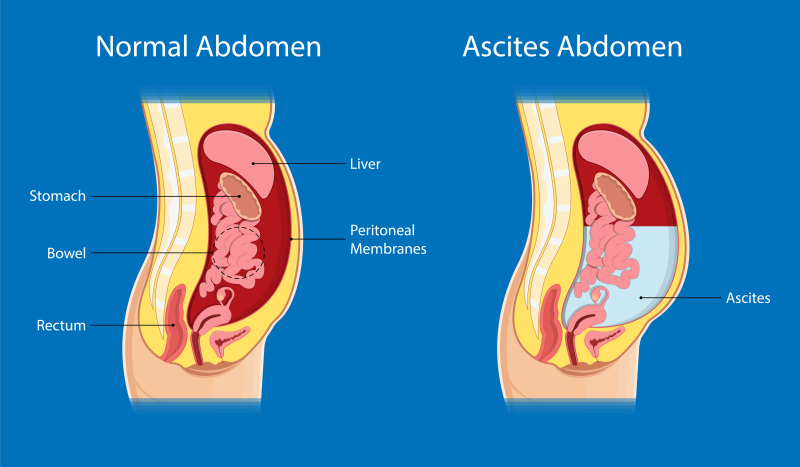 Ascites illustration