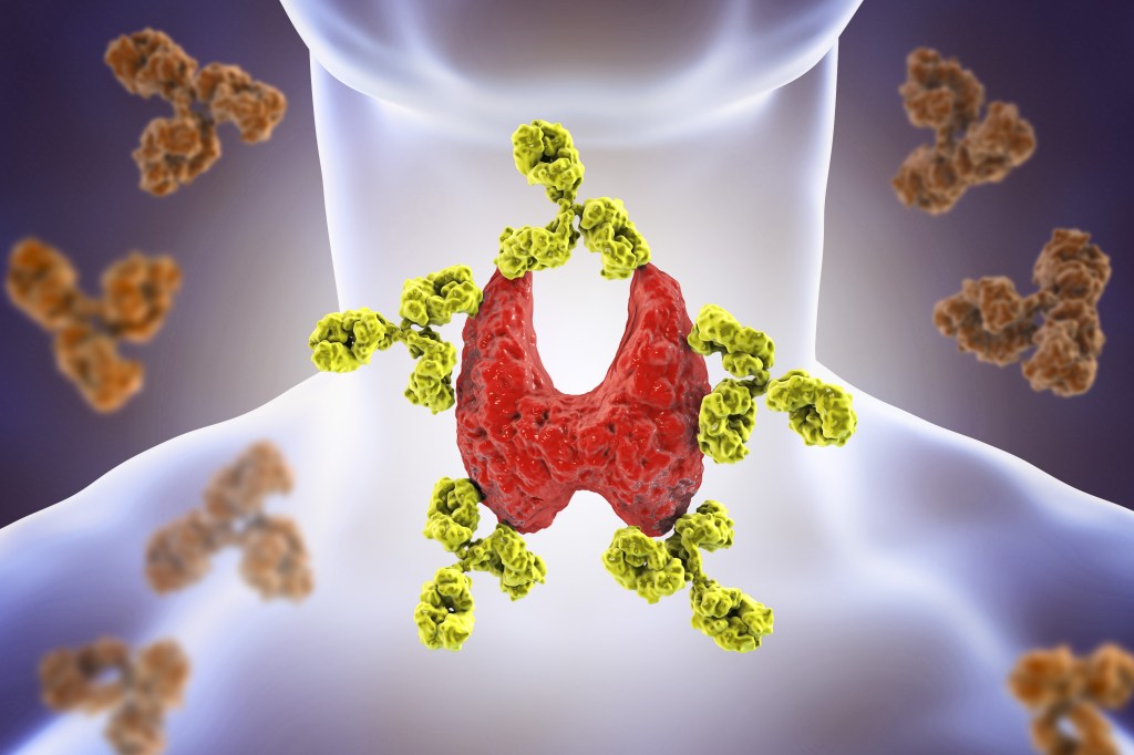 Thyroiditis illustration