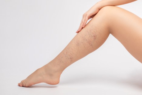 5 Spider Vein Natural Remedies
