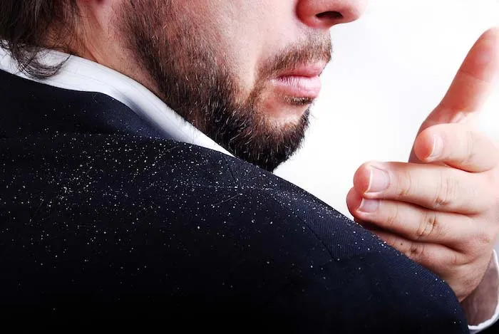 A man wearing a black coat with dandruff on the shoulders. | Best Remedies for Dandruff