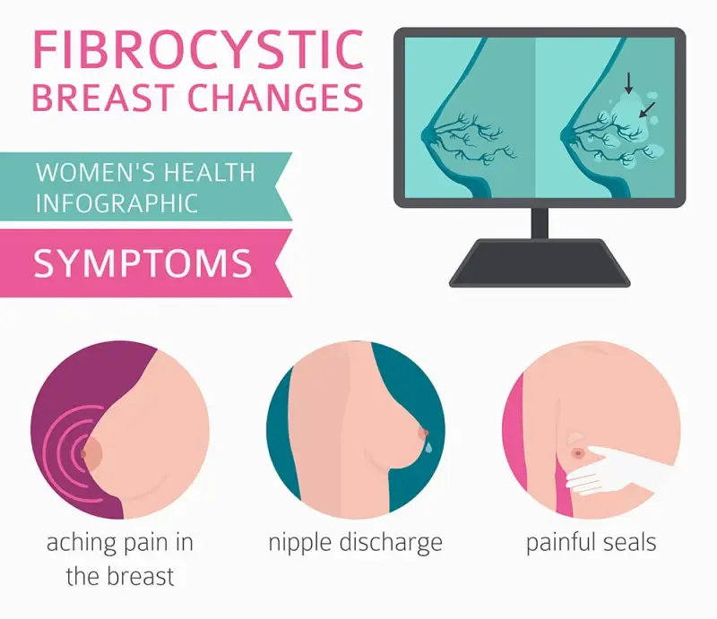 infographic listing changes in fibrocystic breasts