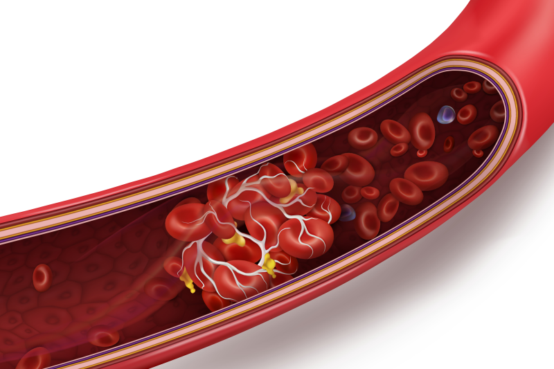 Blood clot illustration