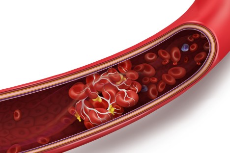 Top 6 Natural Blood Thinners