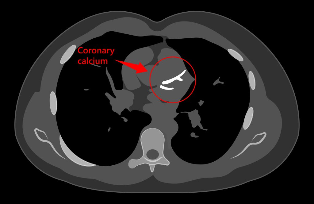 Cardiac calcium test