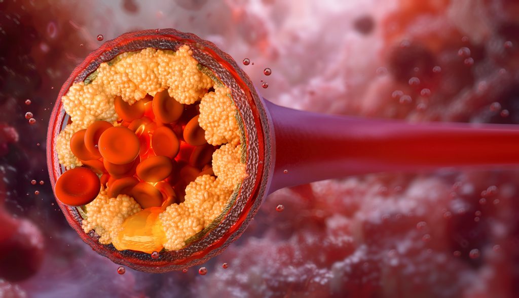 Artery with plaque formation model
