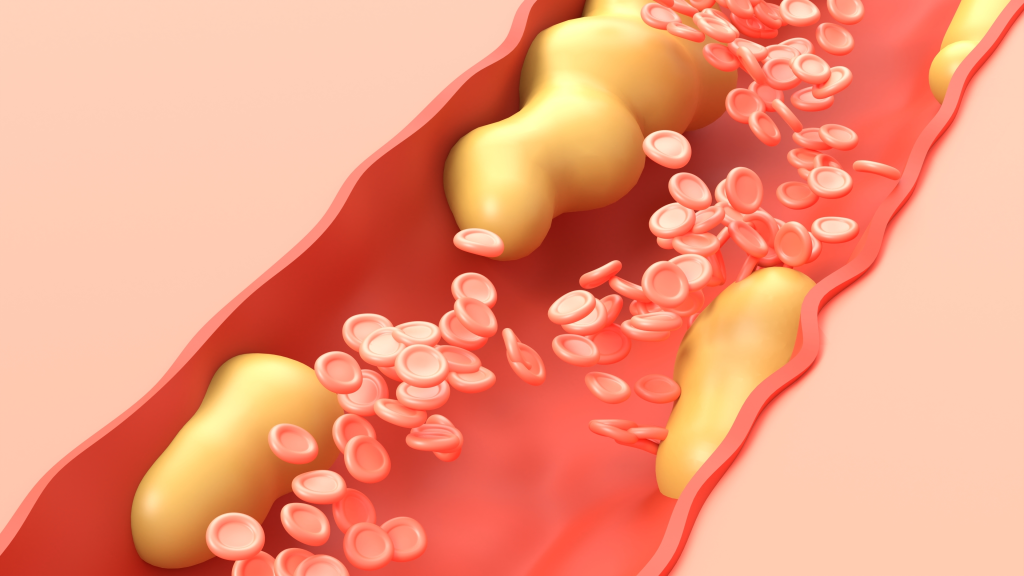 Blood vessel with cholesterol
