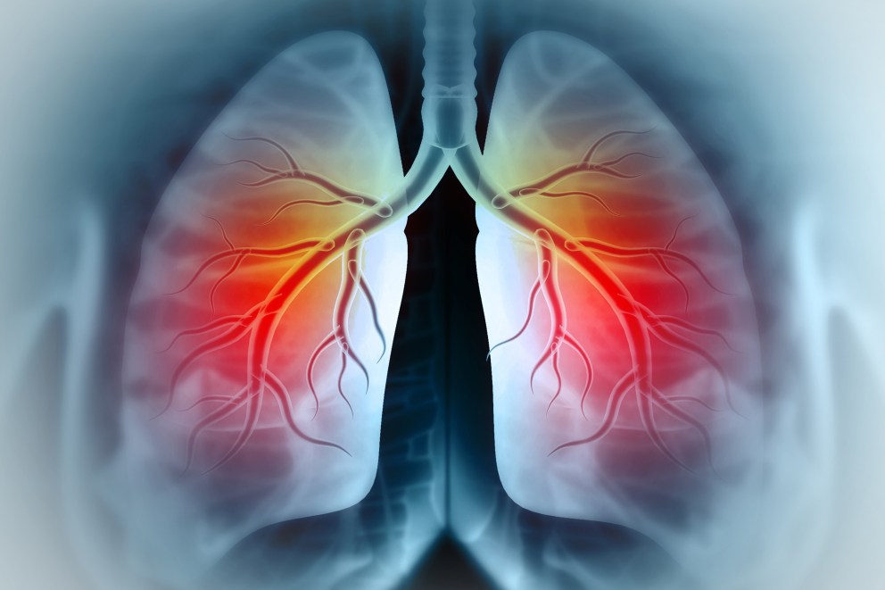 4 Asthma Remedies to Try at Home