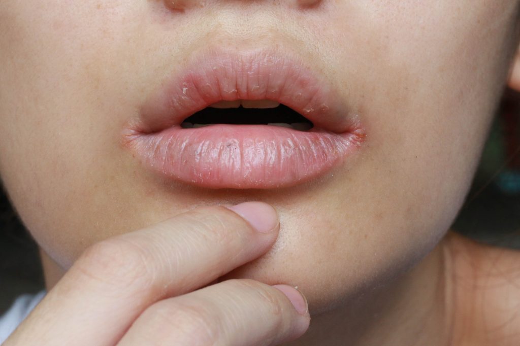 Cracked corners of the mouth