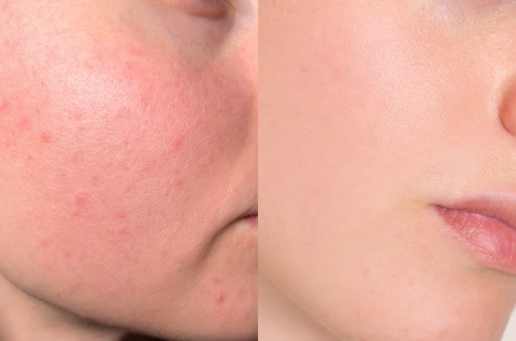 Skin improving