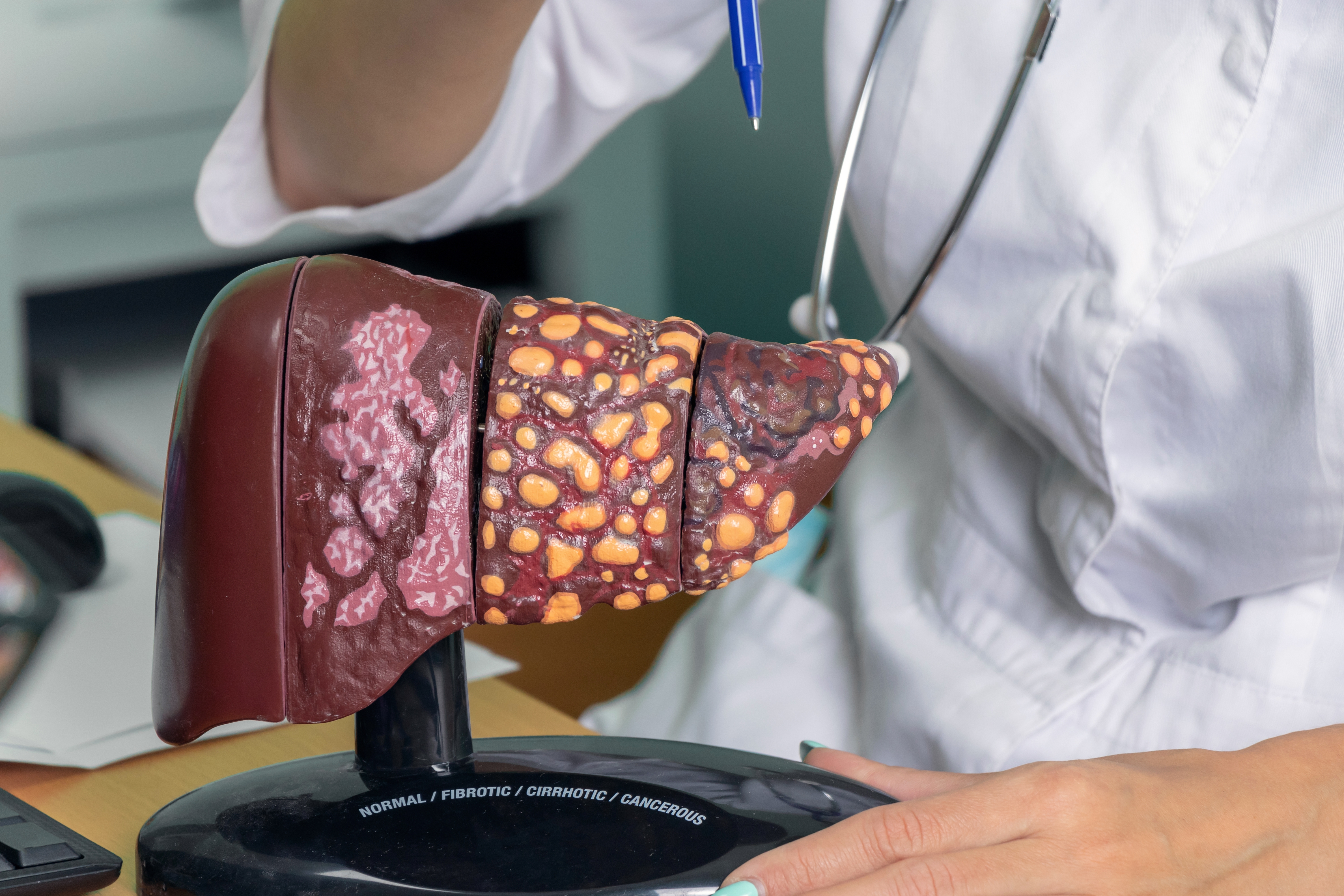 Model of liver health stages