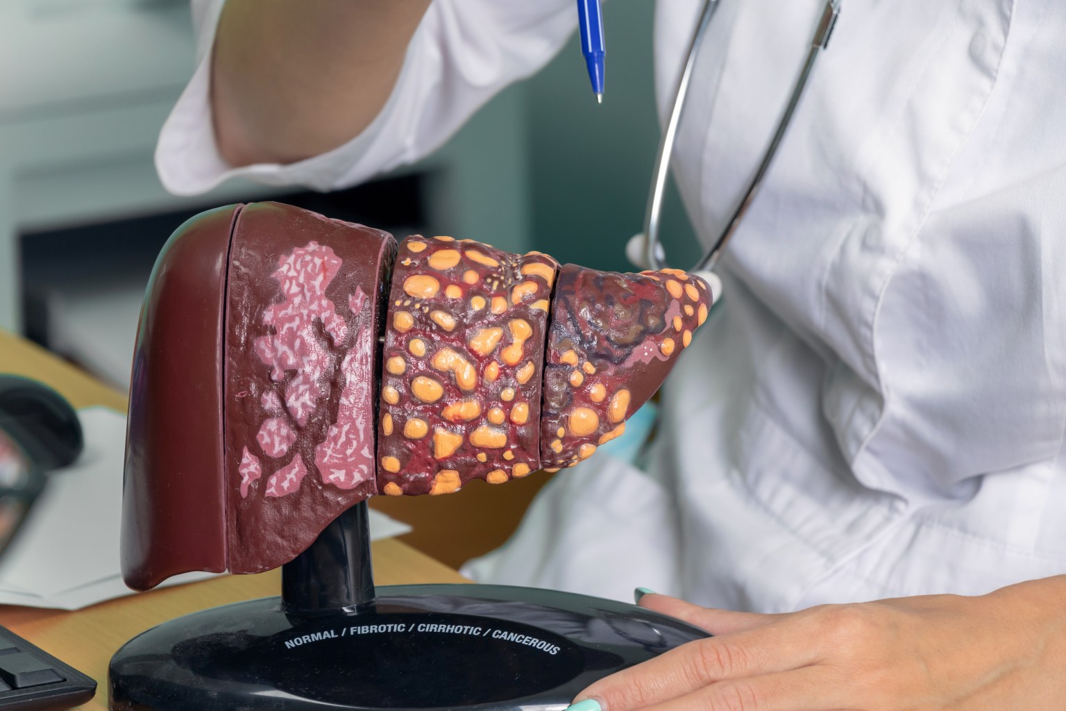 Model of liver health stages