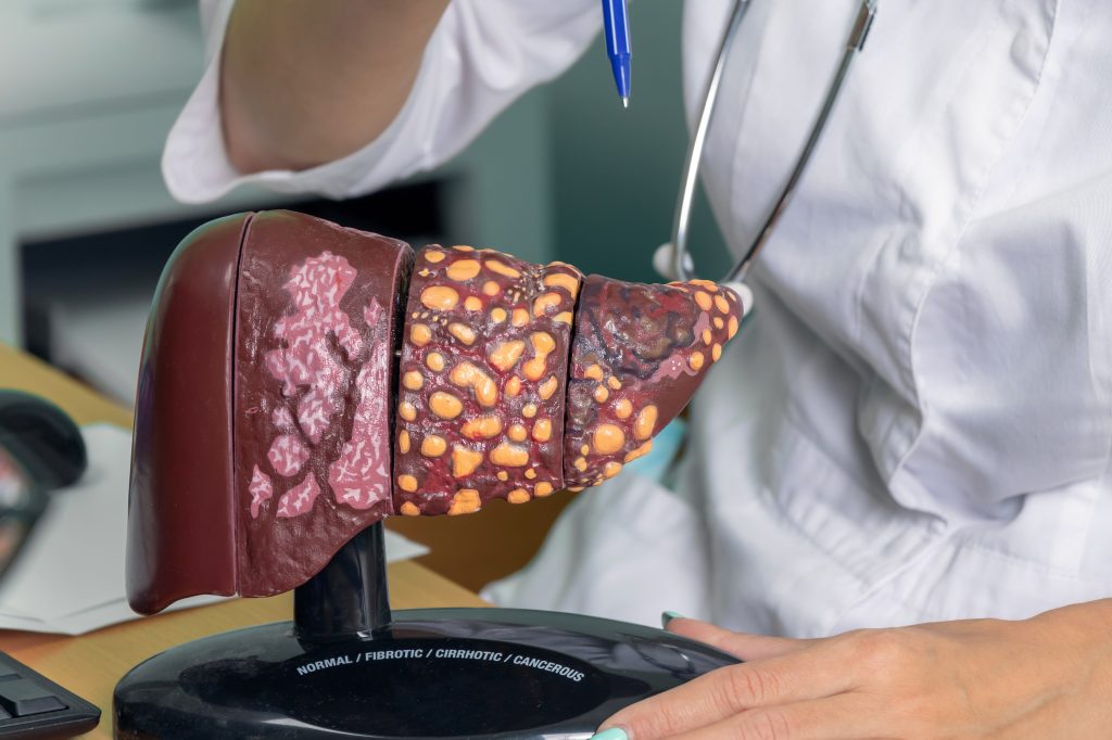 Model of liver health stages