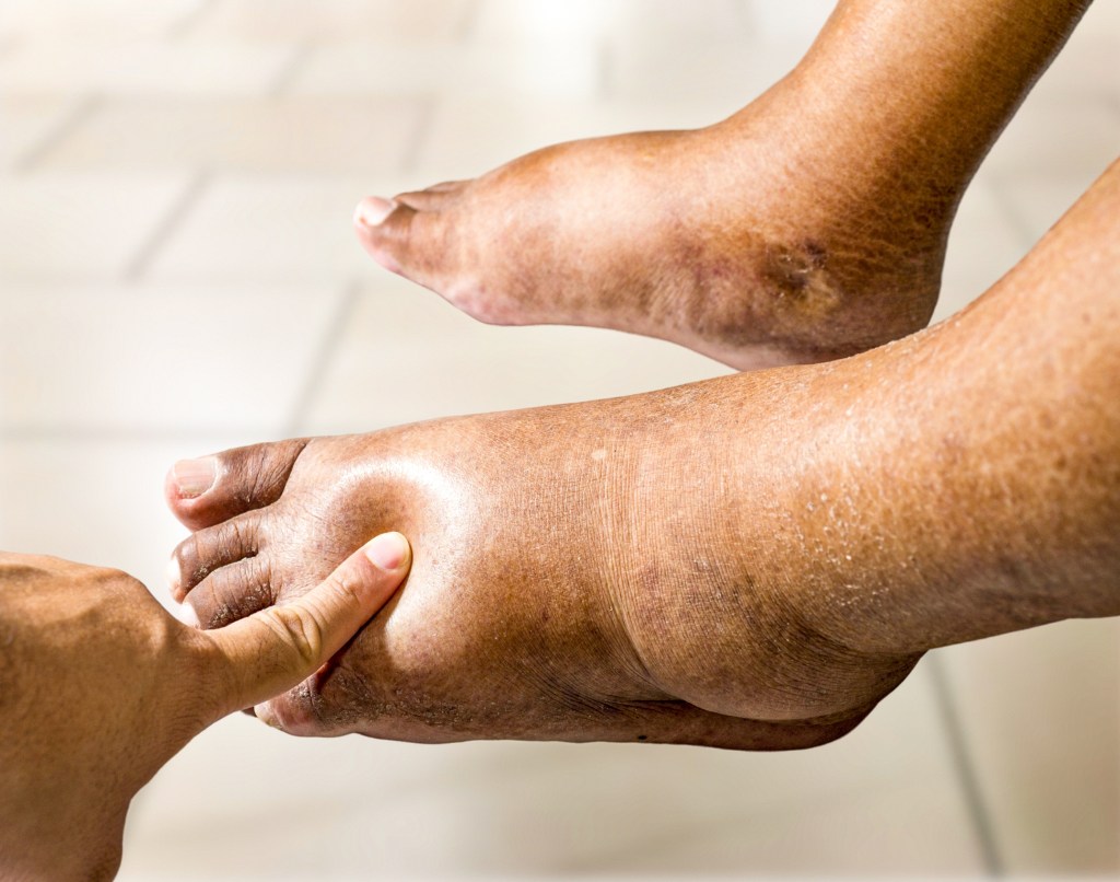 Testing pitting edema on foot