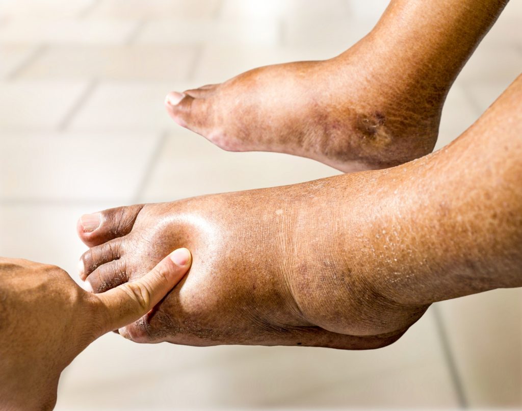 Testing pitting edema on foot