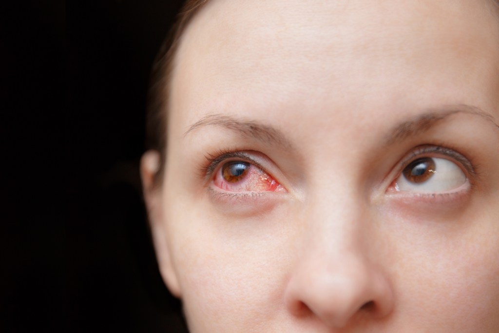 Woman with conjunctivitis