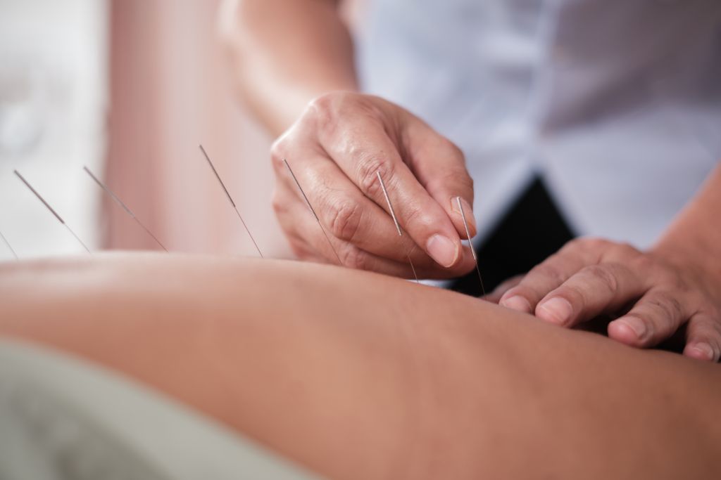 Woman undergoing acupuncture