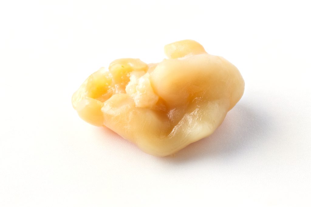Isolated tonsil stone