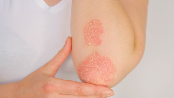 Psoriasis Relief: Everyday Habits for Healthier Skin