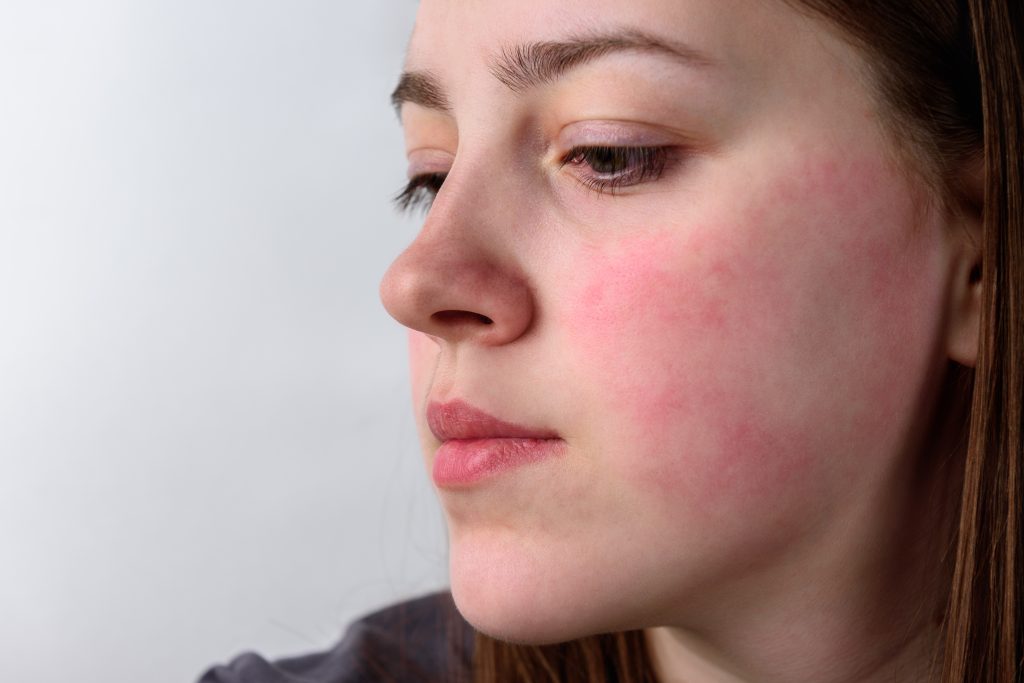 Women with flushed cheeks