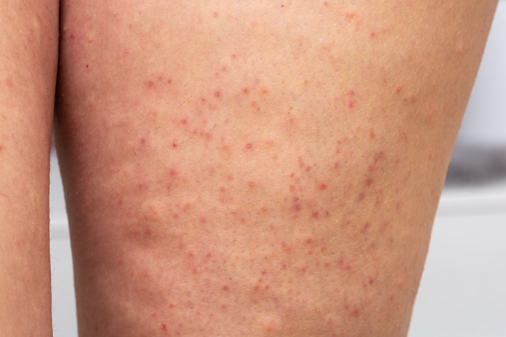 Keratosis pilaris on woman’s legs