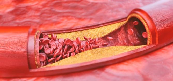 Vitamins & Other Nutrients That Remove Arterial Plaque