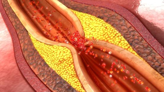 How to Clean Your Arteries – Naturally Prevent Blockage