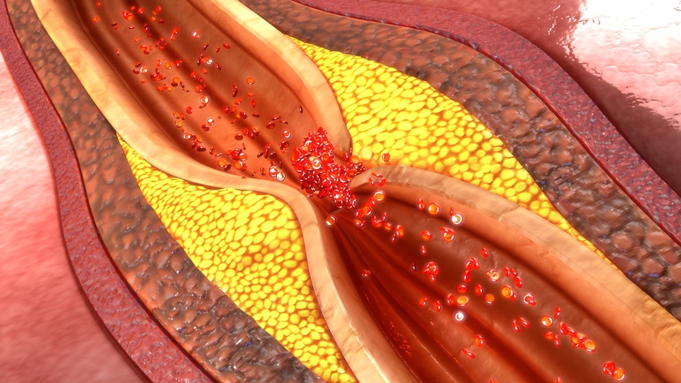 How to Clean Your Arteries – Naturally Prevent Blockage