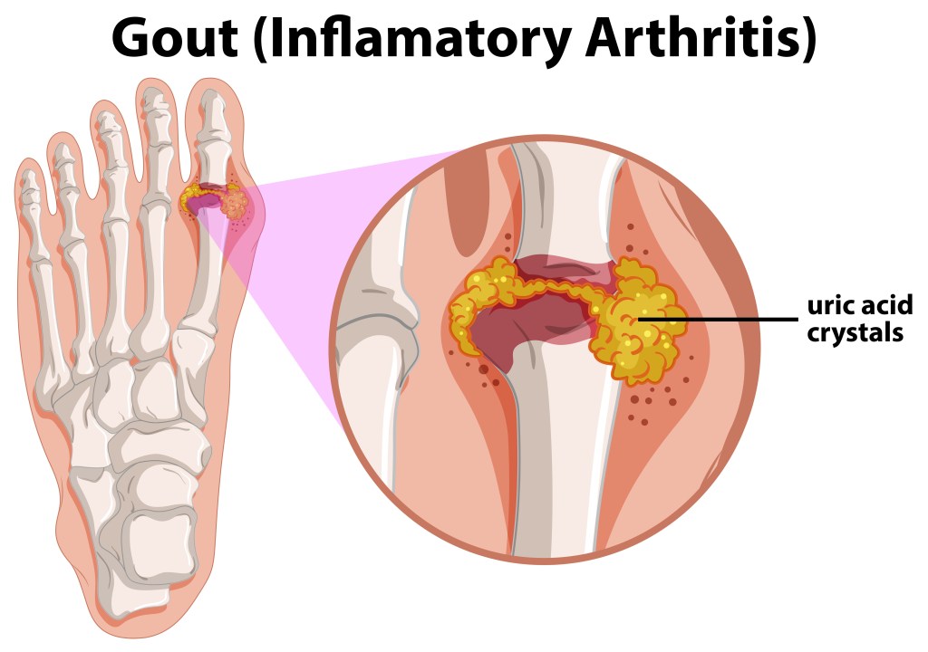 Gout illustration