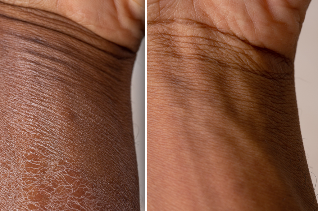 Dry skin before and after