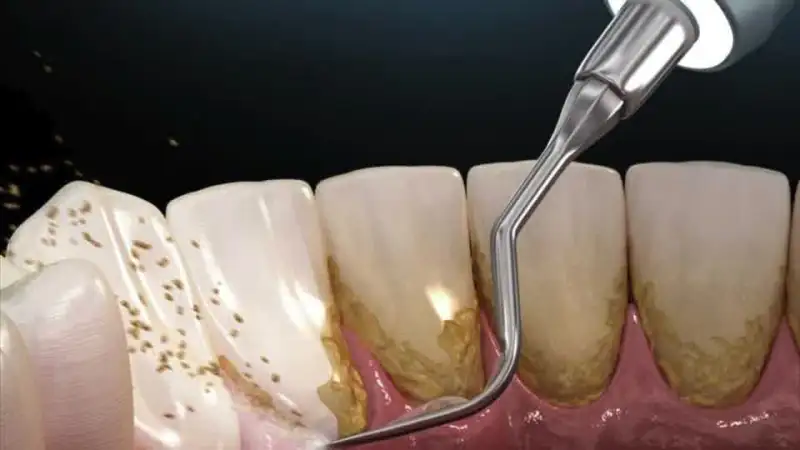 Plaque and tartar removal from teeth with dental scaler