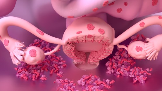 What Causes Endometriosis?