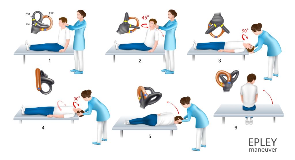 Epley maneuver 