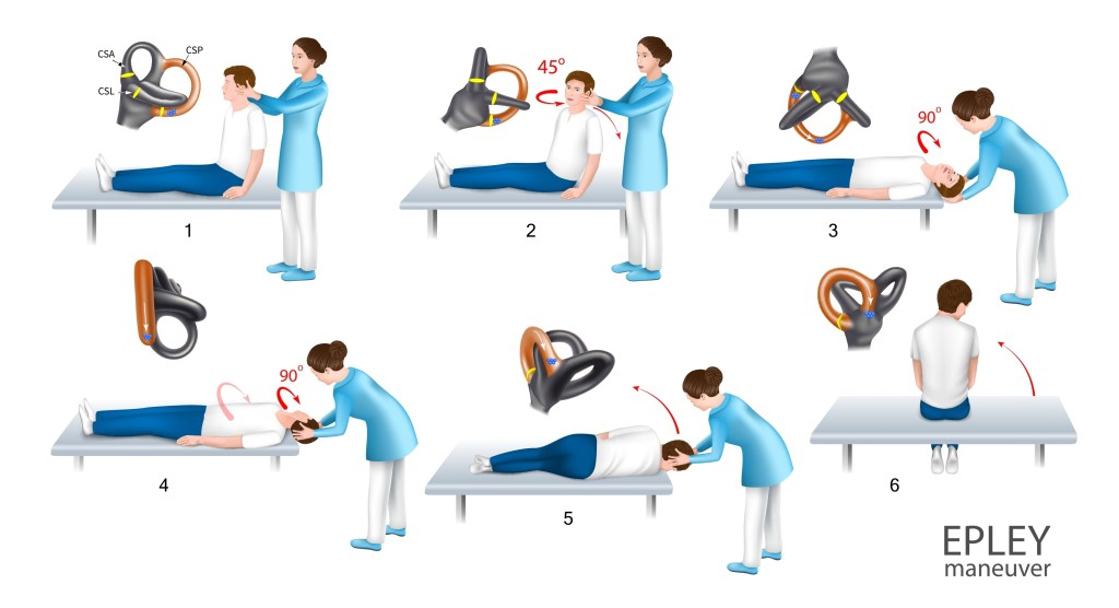 Epley maneuver 