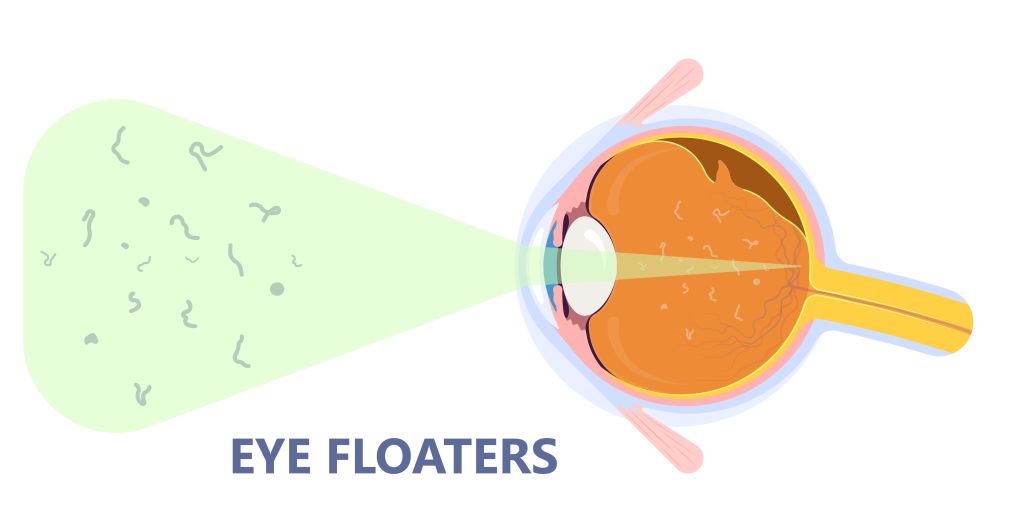 Eye floaters illustration