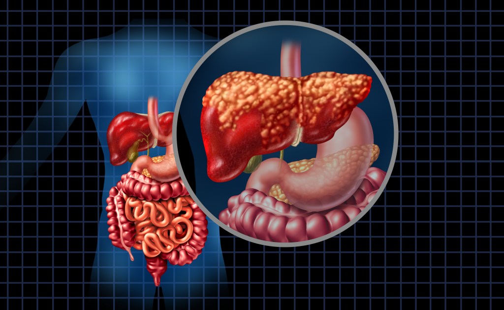 Liver fat illustration