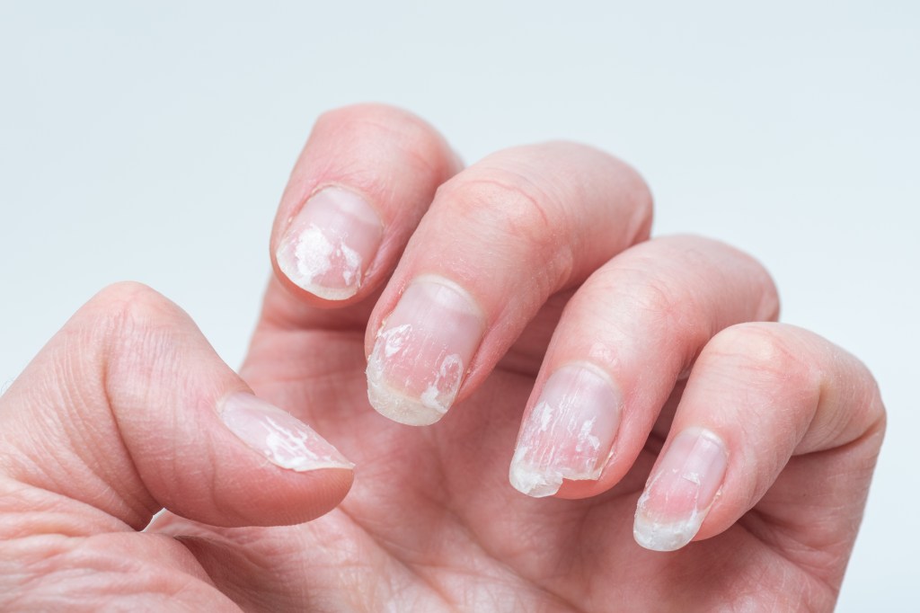 Brittle nails
