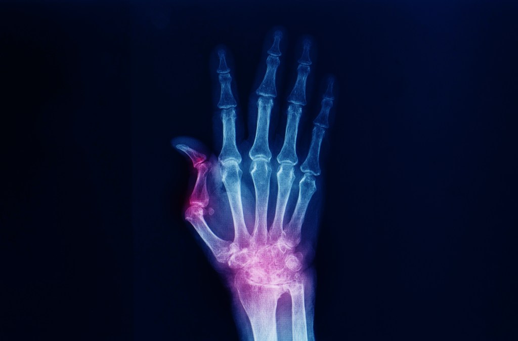 Arthritis hand x-ray