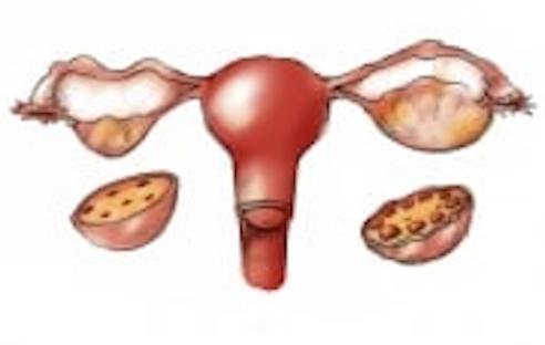 The Cause of Polycystic Ovarian Syndrome
