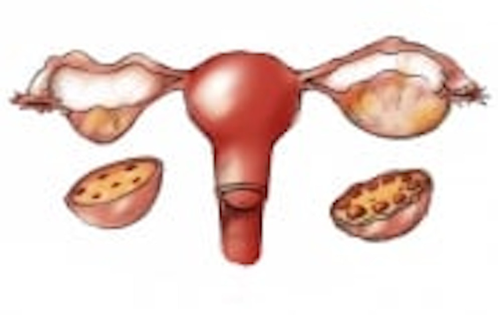 The Cause of Polycystic Ovarian Syndrome