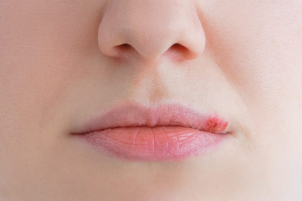 does l-carnitine cause herpes outbreaks Role of carnitine in disease | Nutrition & Metabolism Cold sore treatment: 4 methods