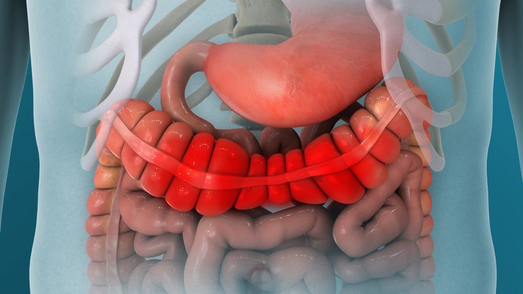 Bowel inflammation