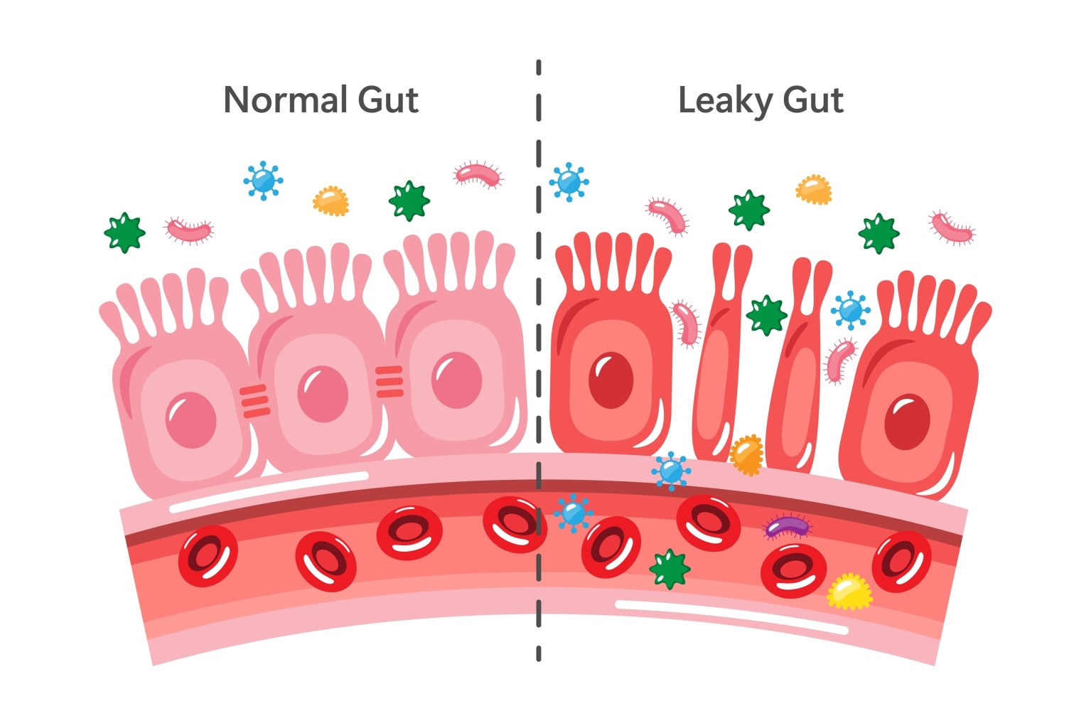 Leaky gut illustration  